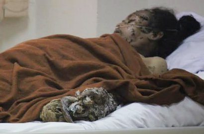 Alami Kegagalan Multiorgan, Dede 'Manusia Akar' Meninggal Dunia