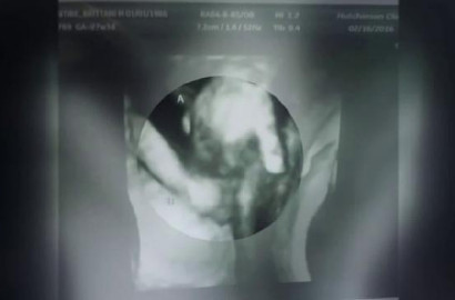 Mengharukan, Foto USG Janin Pegang Tangan Kembaran Sekarat
