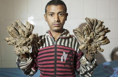 Dioperasi, Manusia Pohon dari Bangladesh Ini Optimis Jalani Hidup