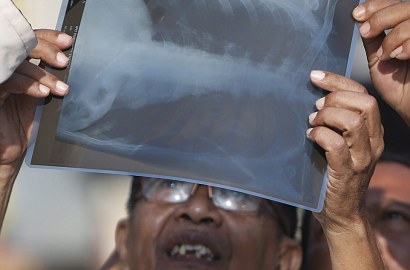 Pakai Foto Rontgen Lihat Gerhana, Pria Ini Tarik Perhatian Media Asing
