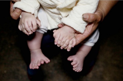 Seorang Bayi di Tiongkok Terlahir Miliki 31 Jari Kaki dan Tangan