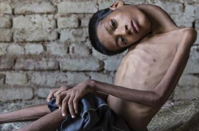 Bocah Berkepala Miring Asal India Akhirnya Dioperasi
