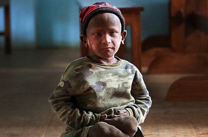 Kena Sindrom Langka, Bocah di Nepal Miliki Kulit Seperti Patung Batu