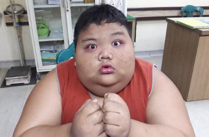 Alami Obesitas Seperti Arya, Kasus Rizki Lebih Sulit Ditangani