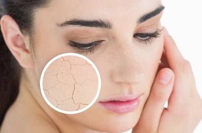 Tampil Mempesona, Begini Ramuan Mudah Menghilangkan Kulit Kering