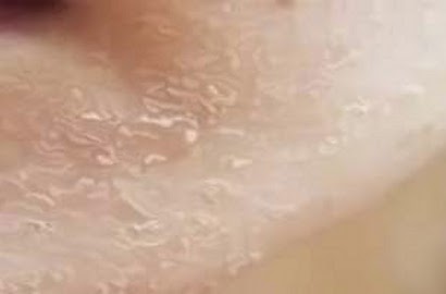 Intip Cara Mudah Singkirkan Penyebab Kulit Terkelupas