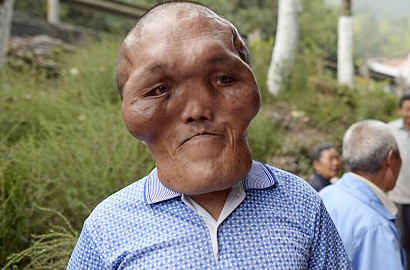 Sungguh Malang, Pria Ini Sakit Hingga Berwajah Seperti Alien