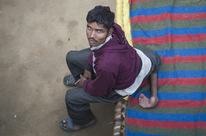Prihatin, Begini Kisah Mengharukan Pria dengan 4 Kaki di India