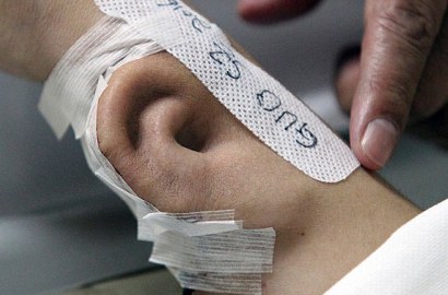 Dokter Ini Ganti Posisi Telinga Pasien di Lengan, Tetap Bisa Dengar?