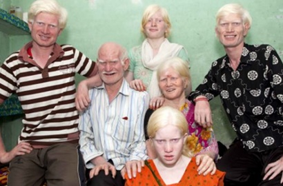 Beranggotakan 10 Orang, Inilah Keluarga Albino Terbesar di Dunia
