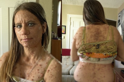 Kasihan, Tubuh Wanita Ini Ditumbuhi Ribuan Tumor