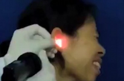 Mengerikan, Video Detik-Detik Dikeluarkannya Kecoak dari Telinga Wanita Ini