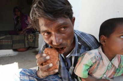 Aneh, Pria Ini Doyan Makan Batu Bata dan Krikil Selama 20 Tahun