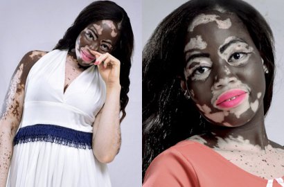 Dibully Sejak Kecil Karena Warna Kulit, Kini Wanita Ini Jadi Model Unik