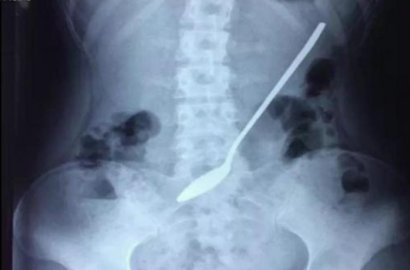 Tak Sengaja Tertelan, Sendok 20 Cm Bersarang di Lambung Remaja Ini