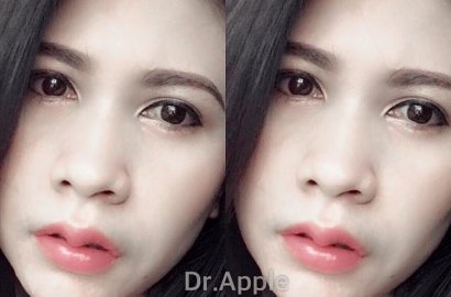 Lagi Tren Di Thailand, Begini Bentuk Bibir Serupa Tanduk Kerbau
