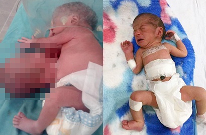 Kasihan, Begini Bentuk Bayi Lahir dengan Tambahan Tubuh Tak Sempurna di India