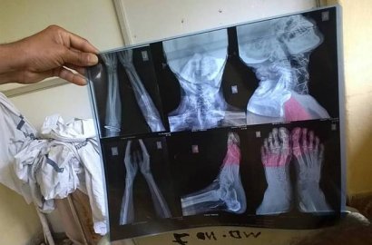 Pria Ini Tiba-Tiba Temukan 75 Jarum dalam Tubuh, Begini Penampakannya