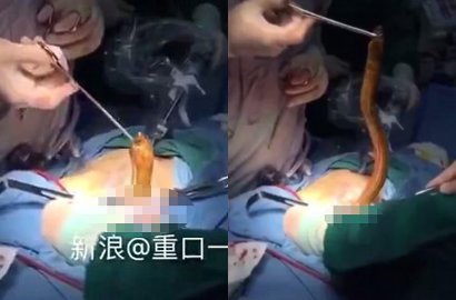 Ada-Ada Saja, Dokter Temukan Belut Utuh Dalam Tubuh Pasien Saat Operasi