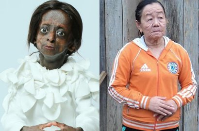 Seperti Cerita di Film-Film, 6 Kisah Haru Dari Wanita yang Idap Penyakit Langka
