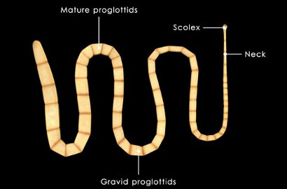 Ngeri Banget! Cacing Pita Sepanjang 5 Meter Keluar dari Anus, Gara-Gara Makan Sushi?