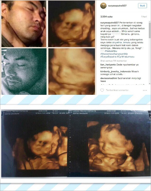 Surya Saputra dan Calon Buah Hati